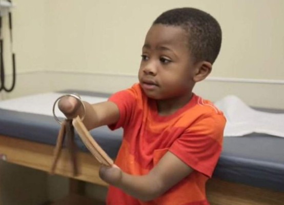 El primer trasplante de manos en un niño es un 'éxito'