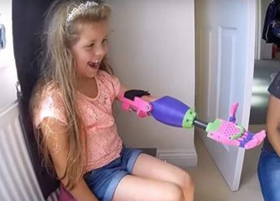 Niña y su brazo biónico