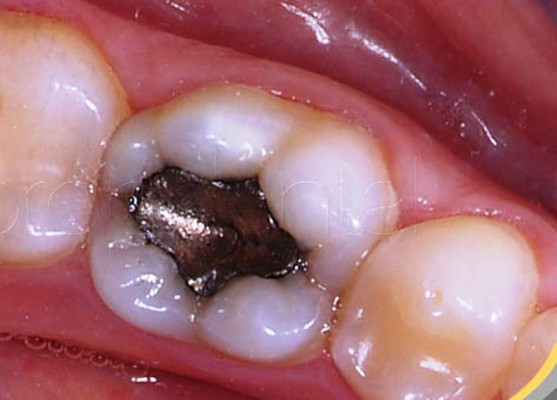 Amalgamas y salud