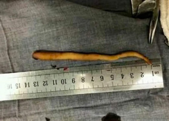 El extraño caso del bebé que nació con 'cola de rata' en Colombia