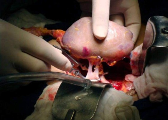 Piden al Legislativo la creación de una Ley de Trasplante de Órganos en Honduras