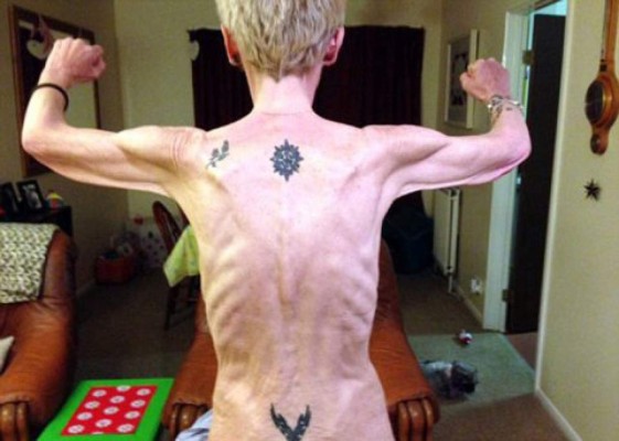 De obesa a anoréxica