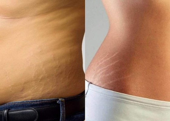 10 remedios caseros para acabar con las estrías ¡Pruébalos!