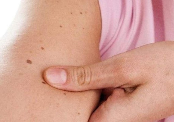 Tener más de 11 lunares en el brazo derecho indica riesgo de melanoma &nbsp;&nbsp;&nbsp;