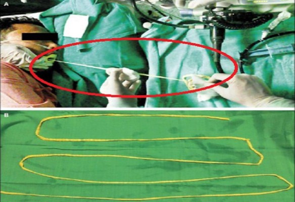 Médicos se sorprenden por solitaria de 1.88 metros extraída a un hindú