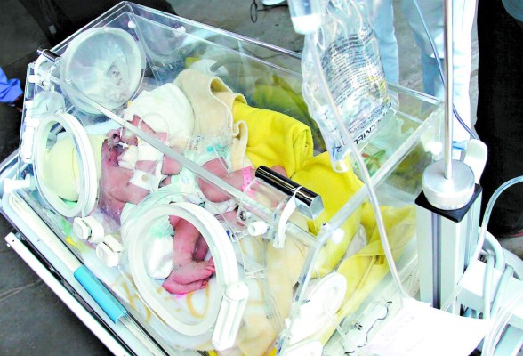 Malformaciones en corazones de siamesas