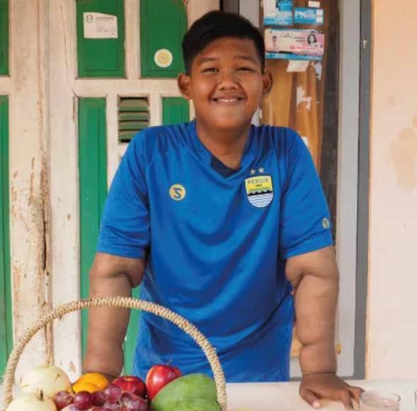 El impactante cambio físico de Arya Permana, el niño más gordo del mundo