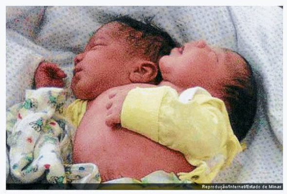 Nacen siameses por cesárea
