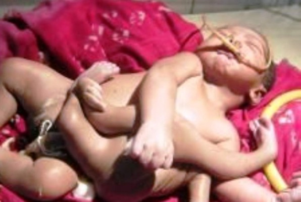 Nació bebé con cuatro piernas y brazos
