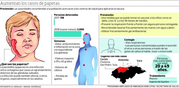 Secretaría de Salud emite alerta por un inusitado brote de paperas