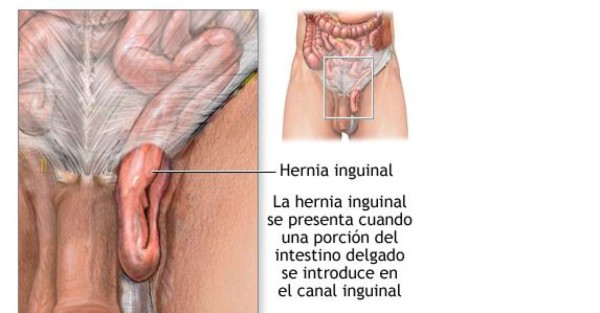 Honduras: Benjamín Bográn padece de una hernia, conforme a evaluaciones médicas