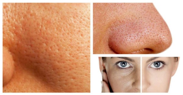Remedios caseros para eliminar los poros abiertos