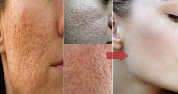 Remedios caseros para eliminar los poros abiertos