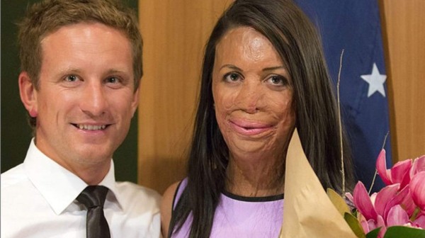 Incendio la deja desfigurada y su novio permanece a su lado