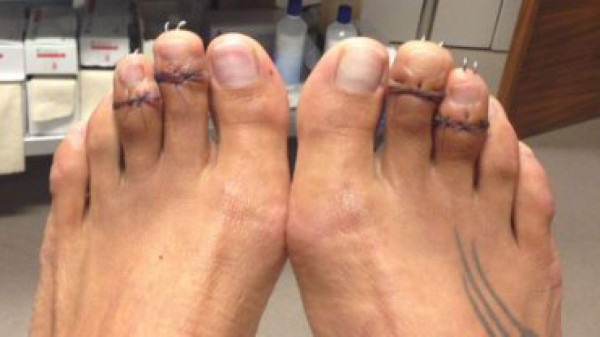 'Cirugía de Cenicienta'