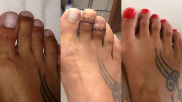 'Cirugía de Cenicienta'