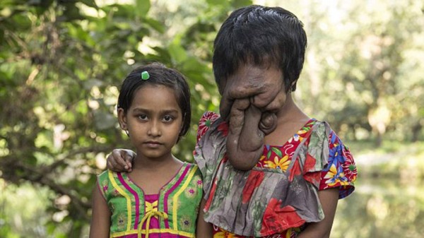 India: La historia de la joven que nació sin cara