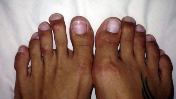 'Cirugía de Cenicienta'