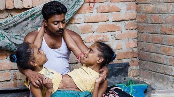 Siamesas unidas se enamoran del mismo hombre