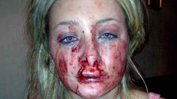 Novio la desfiguró antes que participara en concurso de belleza