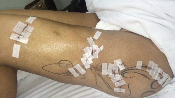 Miss BumBum reveló las horribles secuelas de las cirugías plásticas