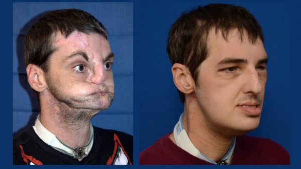 Le trasplantaron la cara y ahora es tapa de una revista de moda