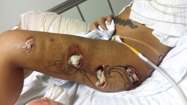 Miss BumBum reveló las horribles secuelas de las cirugías plásticas