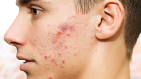 Remedios caseros para curar el acné
