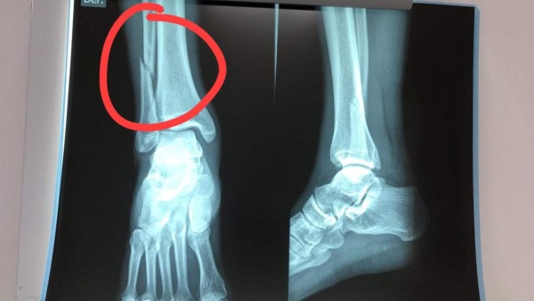 FOTO: Erick Andino sufre doble fractura tras falta recibida por Gerson Chávez