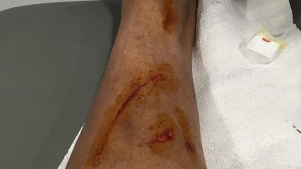 No es grave: Danilo muestra su lesión