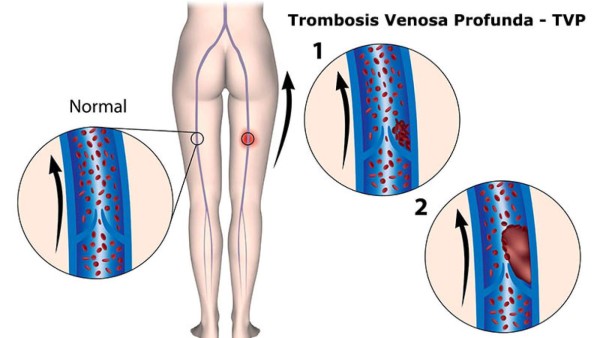 Causas y síntomas: ¿Qué es la trombosis venosa profunda?