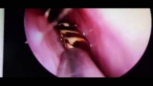 Médico indio extrajo una cucaracha de la cabeza de una mujer