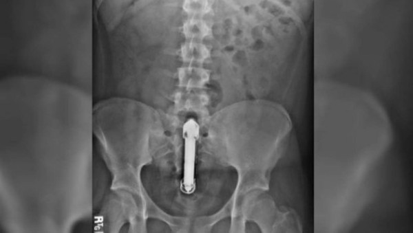 Vibrador le provoca la muerte