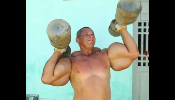 VIDEO: Desarrolló súper músculos con inyecciones de aceite y alcohol