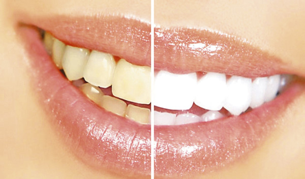 Adiós a las manchas dentales