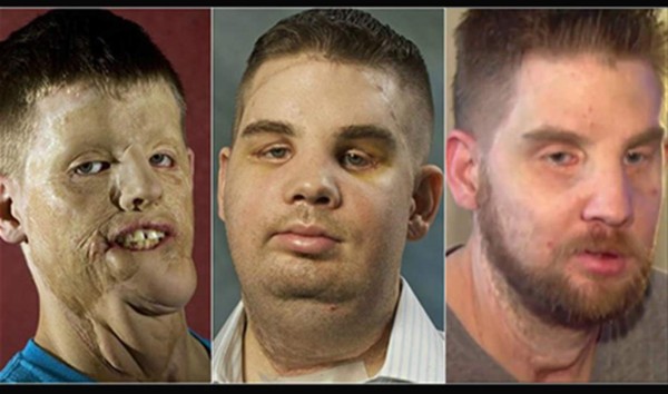 FOTOS: El increíble trasplante de rostro de un soldado