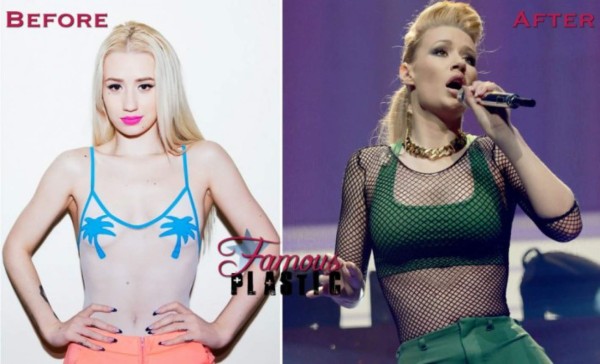 ¿Adicta a las cirugías plásticas? Iggy Azalea reaparece con nuevo rostro