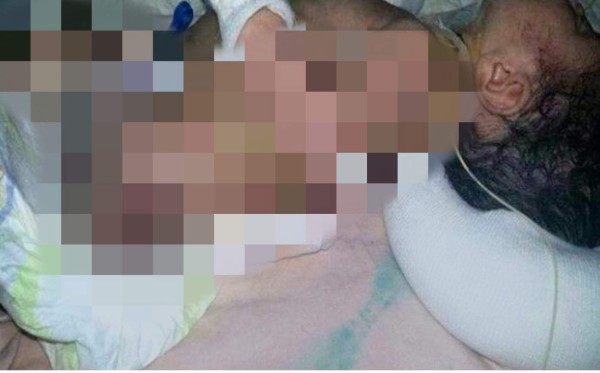 Bebé sufre quemaduras durante operación en el Materno Infantil