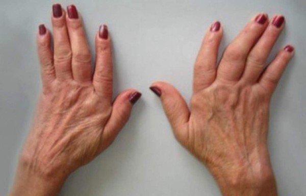 Tronarte los dedos daña la salud de tus manos