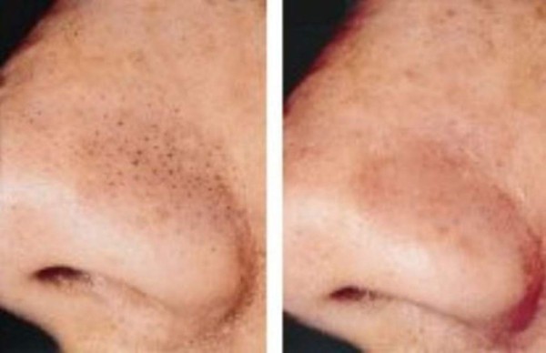 Truco fácil, sin dolor y muy barato para eliminar los puntos negros