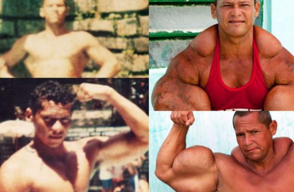 VIDEO: Desarrolló súper músculos con inyecciones de aceite y alcohol