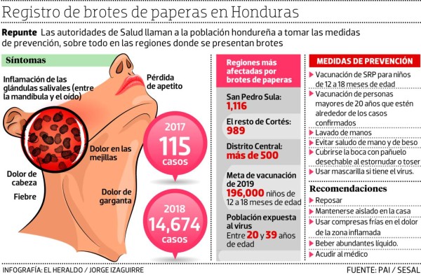Se disparan casos de paperas en tres regiones de Honduras