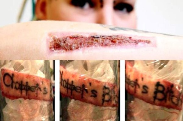 Las insólitas amputaciones que se hizo una mujer británica por estética