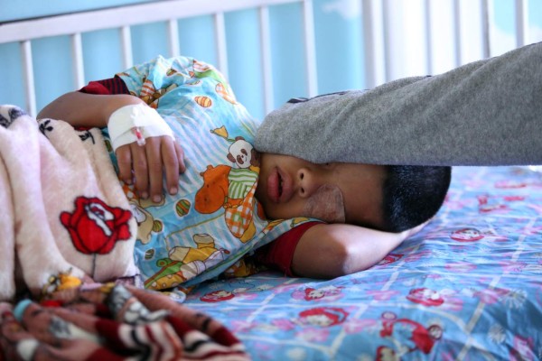 Tres niños más se queman por mal uso de pólvora; cifra de víctimas sube a 71