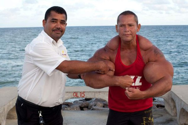 VIDEO: Desarrolló súper músculos con inyecciones de aceite y alcohol