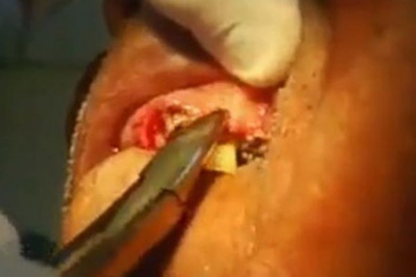 Encía llena de gusanos