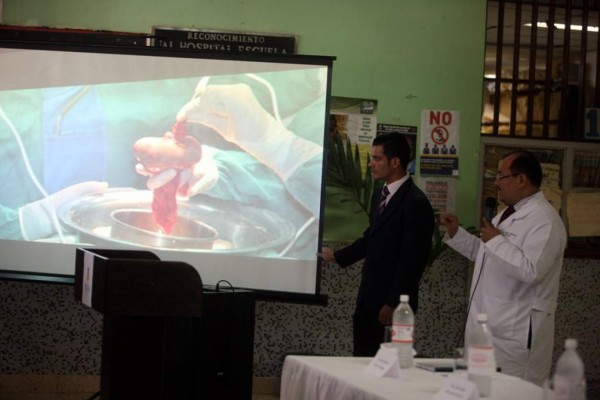 Honduras: Adiós a las cirugías por cálculos con bisturí