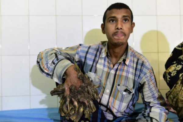 Hombre árbol vuelve a ver sus manos tras someterse a 16 cirugías