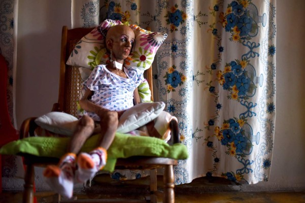 Colombia: niña con progeria cumple 15 años con aspecto de 90
