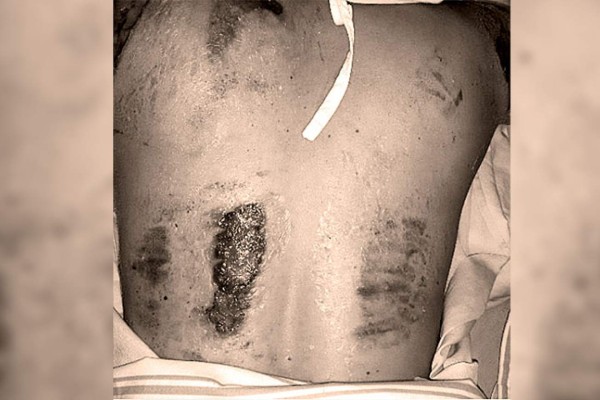 Modelo muestra quemaduras sufridas en incendio